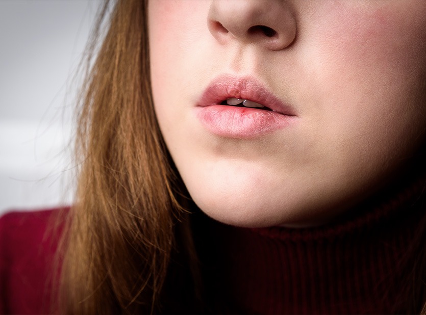 Scopri come riconoscere e trattare le Ragadi con Hyperoil la linea RIMOS CARE